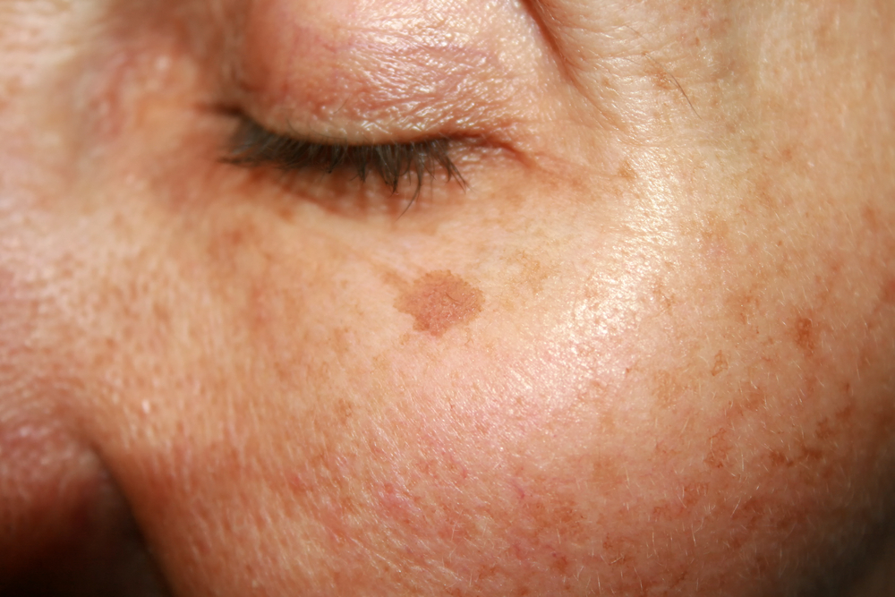 What are Age Spots?
