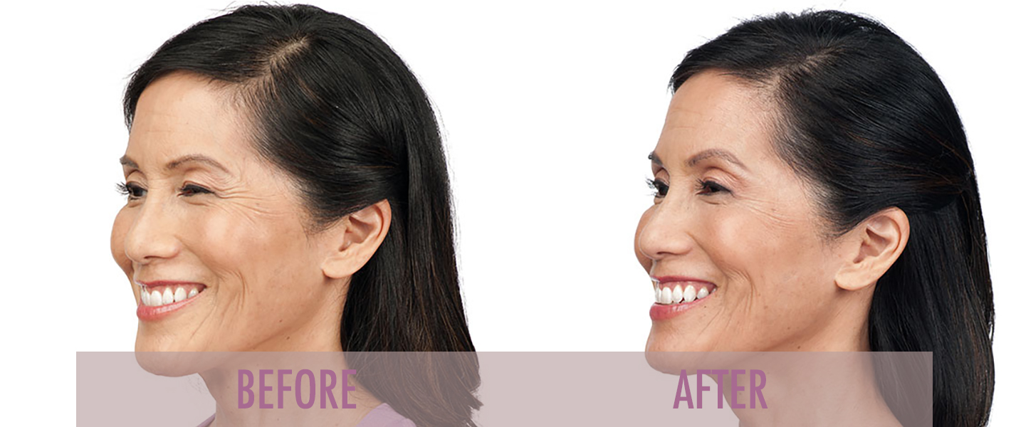 Before and after Botox Crows Feet treatment.