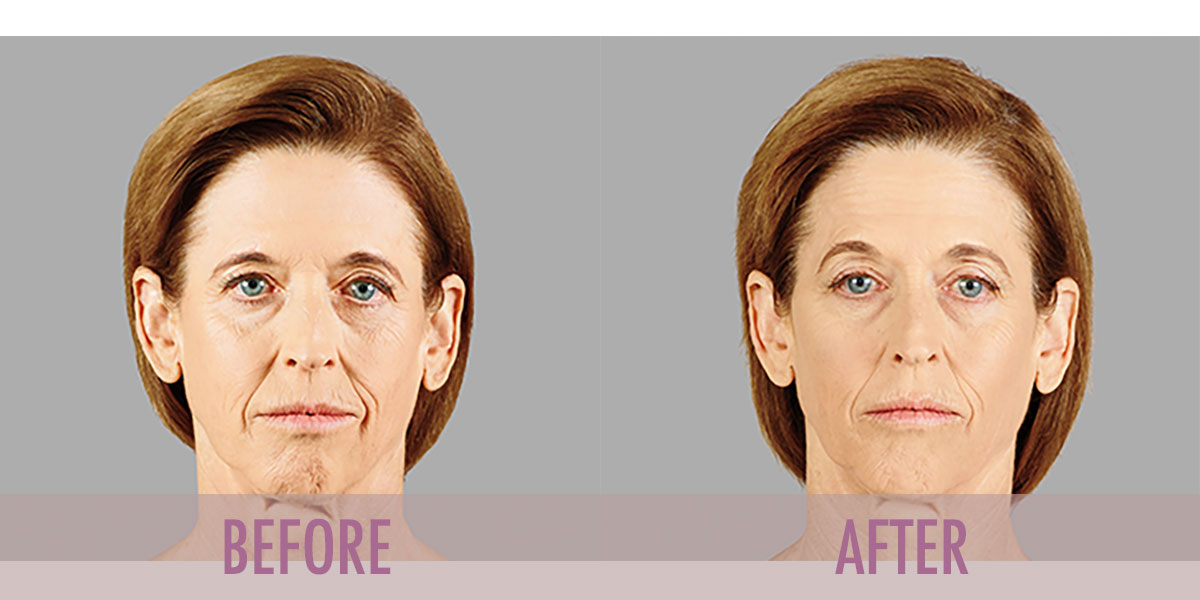 Before and after Voluma Treatment.