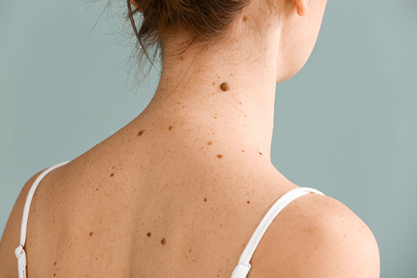 The Ultimate Guide to Moles