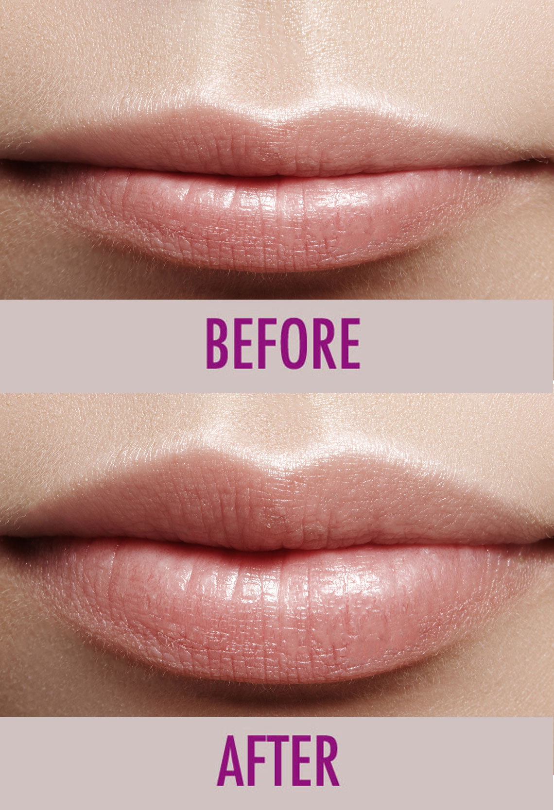 Lip Fillers in Chicago Lip Augmentation Comsetic Medicine in Chicago